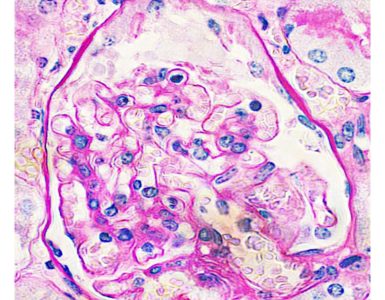 Glomerular pathology