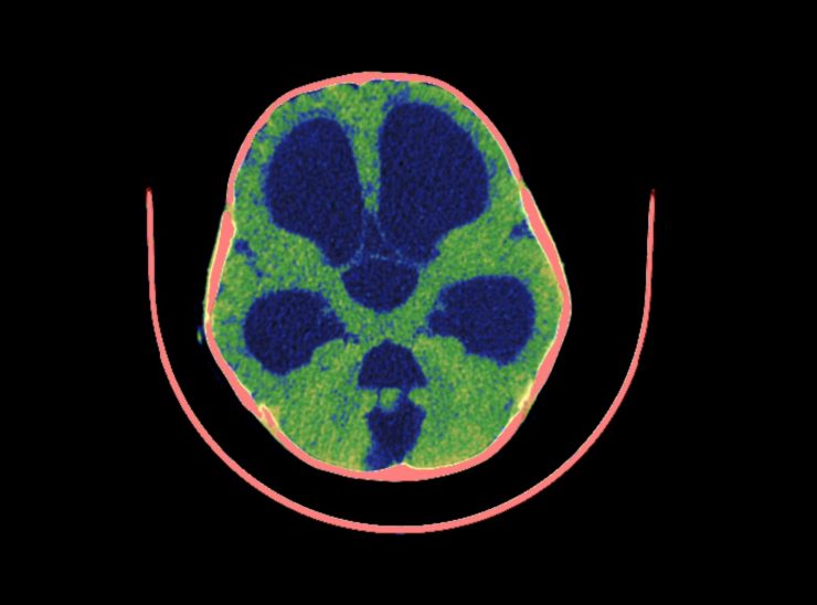 Hydrocephalusgettyimages